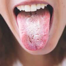 Thrush on tongue
